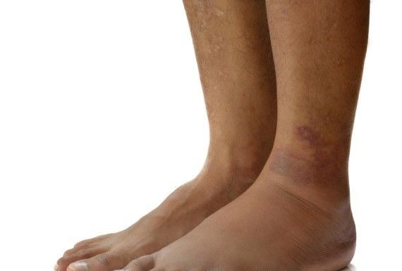 Swollen legs are no sign of twins